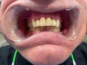 After Dental Implant Placement