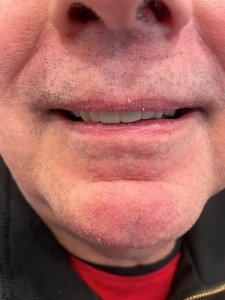 After Upper Dental Veneers Placement