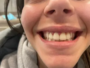 After dental veneer placement on front tooth