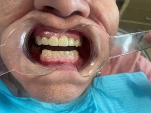 After photo of dental implant upper retained denture