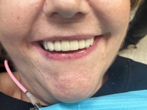 After photo of Dental bridge from Tri-County Dental Care