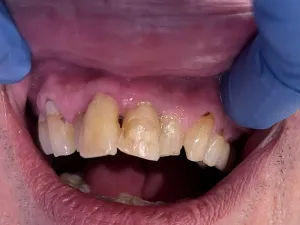 Before photos of discolored and heavily decayed teeth