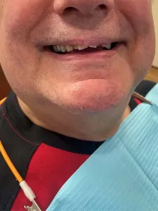 Before picture of broken and discolored teeth