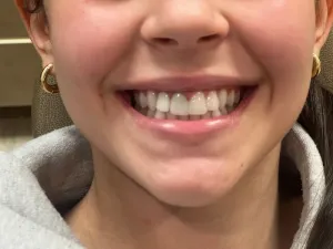 Before Dental Veneer Placement