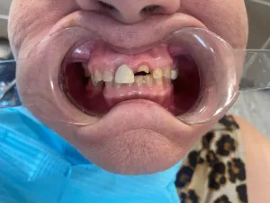 Before picture of broken and discolored teeth